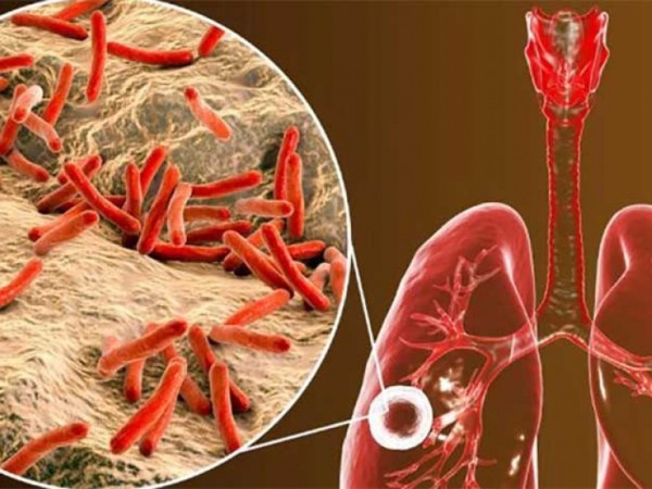 Maldonado está sobre la media uruguaya de tuberculosis que aumenta y se desplaza a grupos etarios más jóvenes