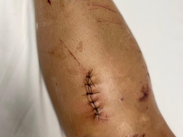 “No respetó la preferencia”: joven motociclista deberá someterse a una operación tras ser embestida por un auto