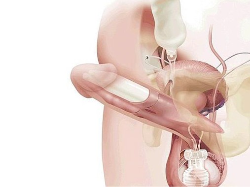 Inédita operación en Uruguay: Cómo funciona la prótesis hidráulica de pene, que cuesta US$ 10 mil